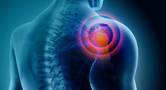 Principais causas de dores no ombro | Clínica Phitris